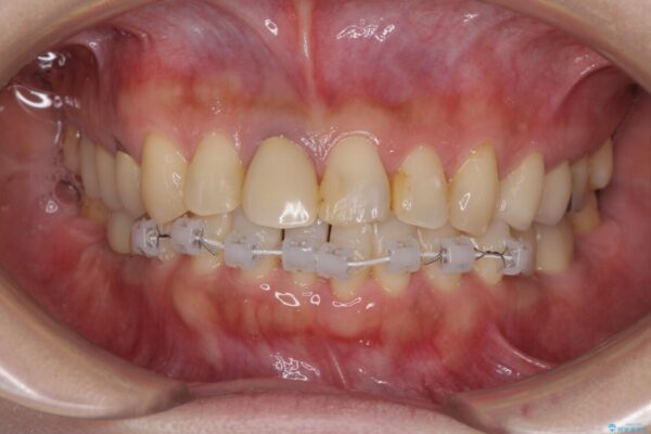 気になる部分を全て治療　総合歯科治療で口腔内環境改善 治療途中画像