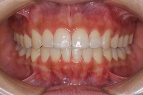 前歯のデコボコが気になる　インビザラインによる矯正治療 治療後画像