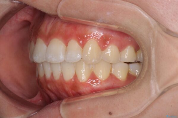 前歯のデコボコが気になる　インビザラインによる矯正治療 治療後画像