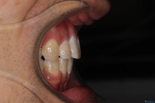 前歯の強いガタつきを解消　ワイヤー装置での抜歯矯正 治療後画像