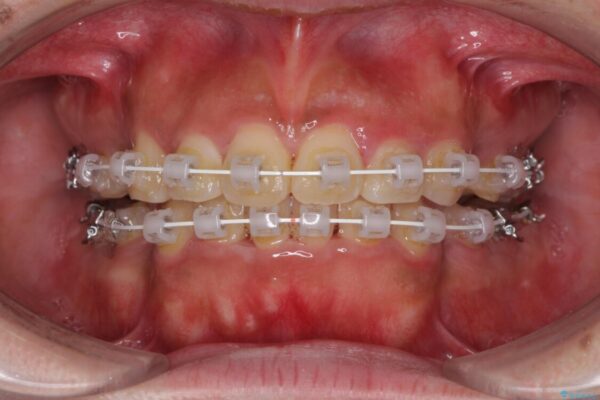 口元の突出感を改善　ワイヤー装置による抜歯矯正 治療途中画像