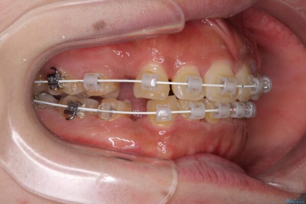 口元の突出感を改善　ワイヤー装置による抜歯矯正 治療途中画像