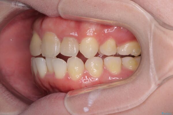 抜歯矯正の後戻り　インビザラインによるオープンバイトの再矯正 治療途中画像