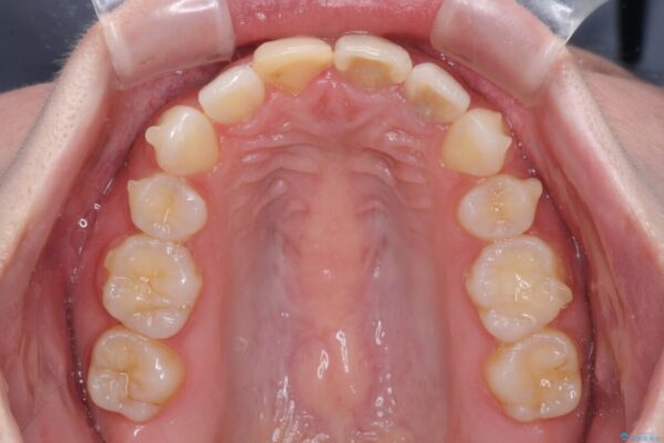 抜歯矯正の後戻り　インビザラインによるオープンバイトの再矯正 治療途中画像