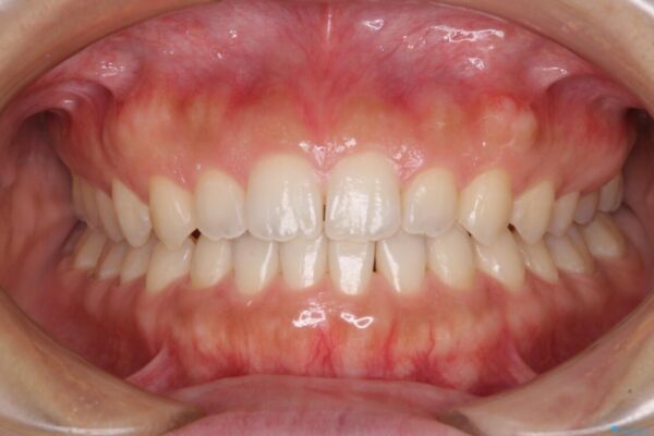 気になる隙間の再矯正　前歯をインビザライン・ライトで改善 治療途中画像