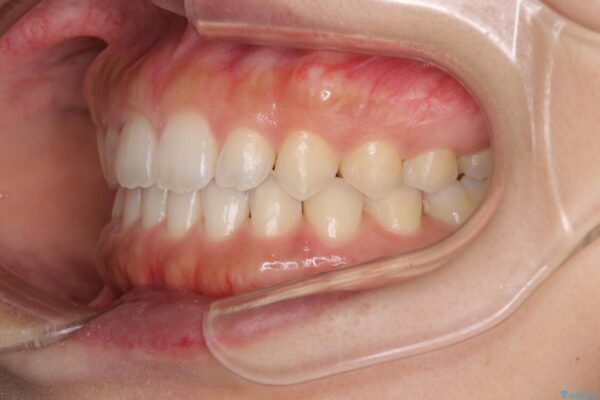 気になる隙間の再矯正　前歯をインビザライン・ライトで改善 治療途中画像