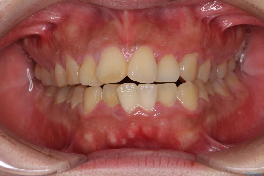 口元の突出感を改善　ワイヤー装置による抜歯矯正 治療前