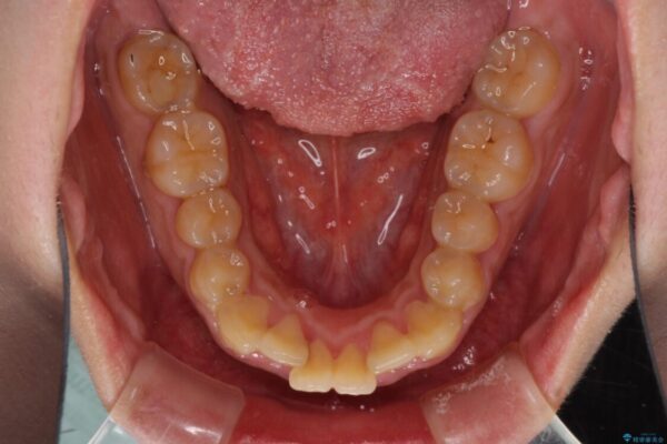 口元の突出感を改善　ワイヤー装置による抜歯矯正 治療前画像