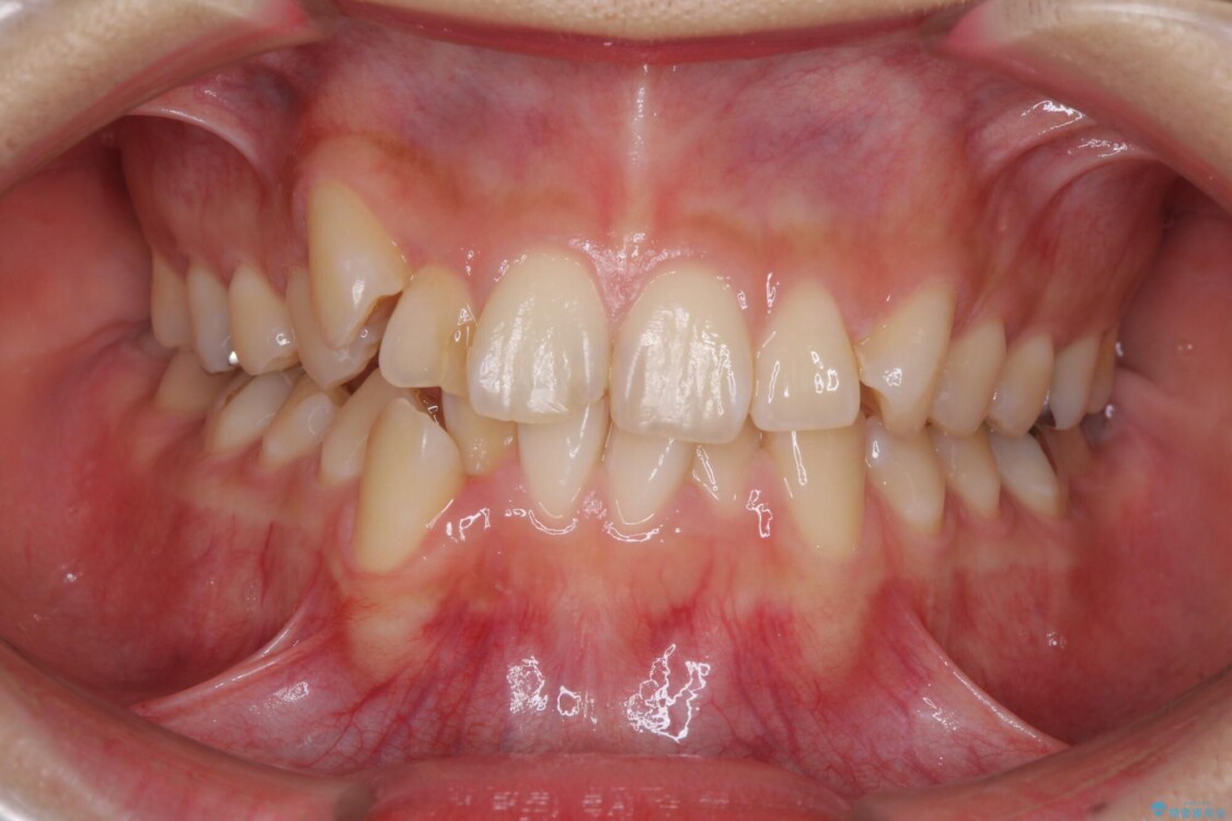 上下の八重歯を治したい　補助装置を用いたインビザライン矯正 治療前