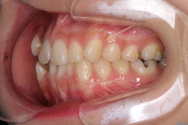 上下の八重歯を治したい　補助装置を用いたインビザライン矯正 治療前画像