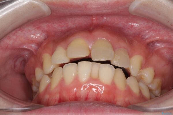 抜歯矯正の後戻り　インビザラインによるオープンバイトの再矯正 治療前画像