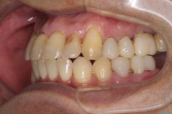 歯周病治療のための歯列矯正　総合歯科治療による全顎治療 治療途中画像