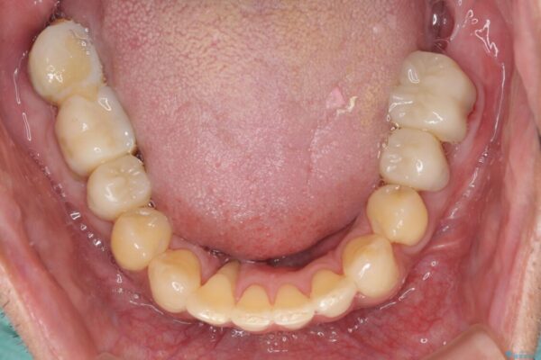 歯周病治療のための歯列矯正　総合歯科治療による全顎治療 治療途中画像