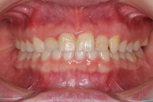 気になる前歯を美しく　マウスピース矯正とセラミッククラウン 治療途中画像