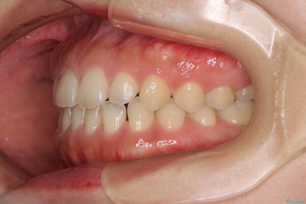 気になる隙間の再矯正　前歯をインビザライン・ライトで改善 治療前画像