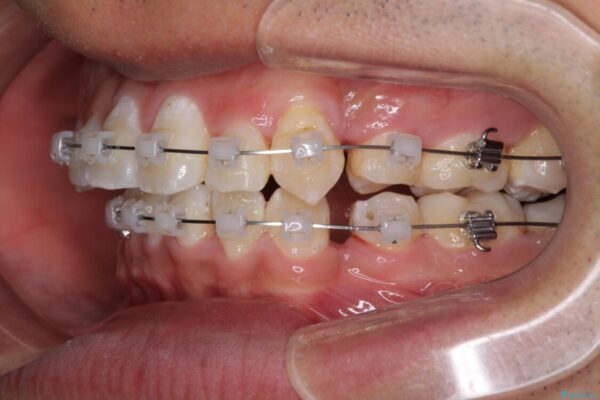 前歯の強いガタつきを解消　ワイヤー装置での抜歯矯正 治療途中画像