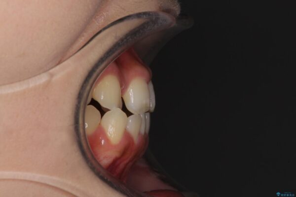 外科矯正は受けたくない　上顎骨拡大による妥協的な受け口治療 治療前画像