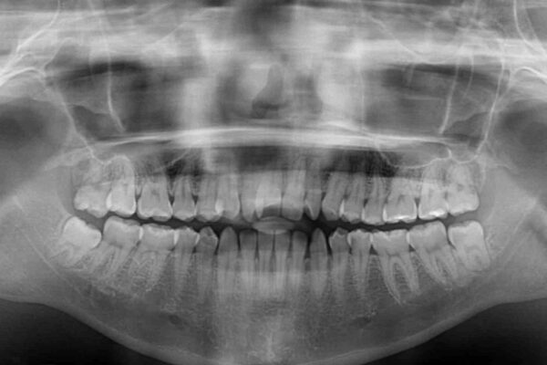 外科矯正は受けたくない　上顎骨拡大による妥協的な受け口治療 治療前画像