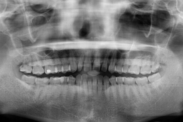 前歯の歯並びと小さい歯を改善　インビザラインとオールセラミッククラウン 治療前画像