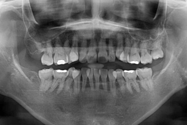 矯正の後戻りと変色歯を治したい　総合歯科診療 治療前画像