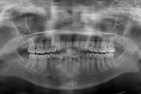 外科矯正は受けたくない　上顎骨拡大による妥協的な受け口治療 治療後画像