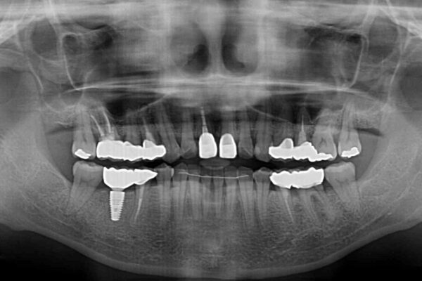 気になる部分を全て治療　総合歯科治療で口腔内環境改善 治療後画像