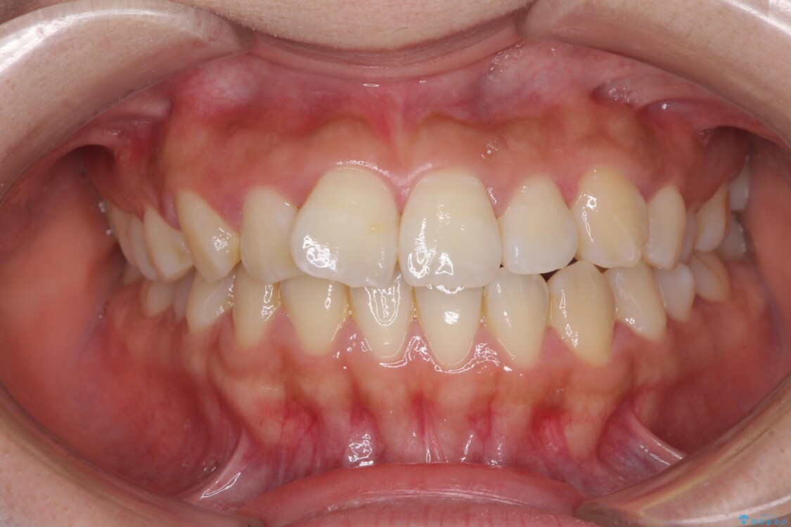 軽微な歯列不正をワイヤー矯正で整える 治療前