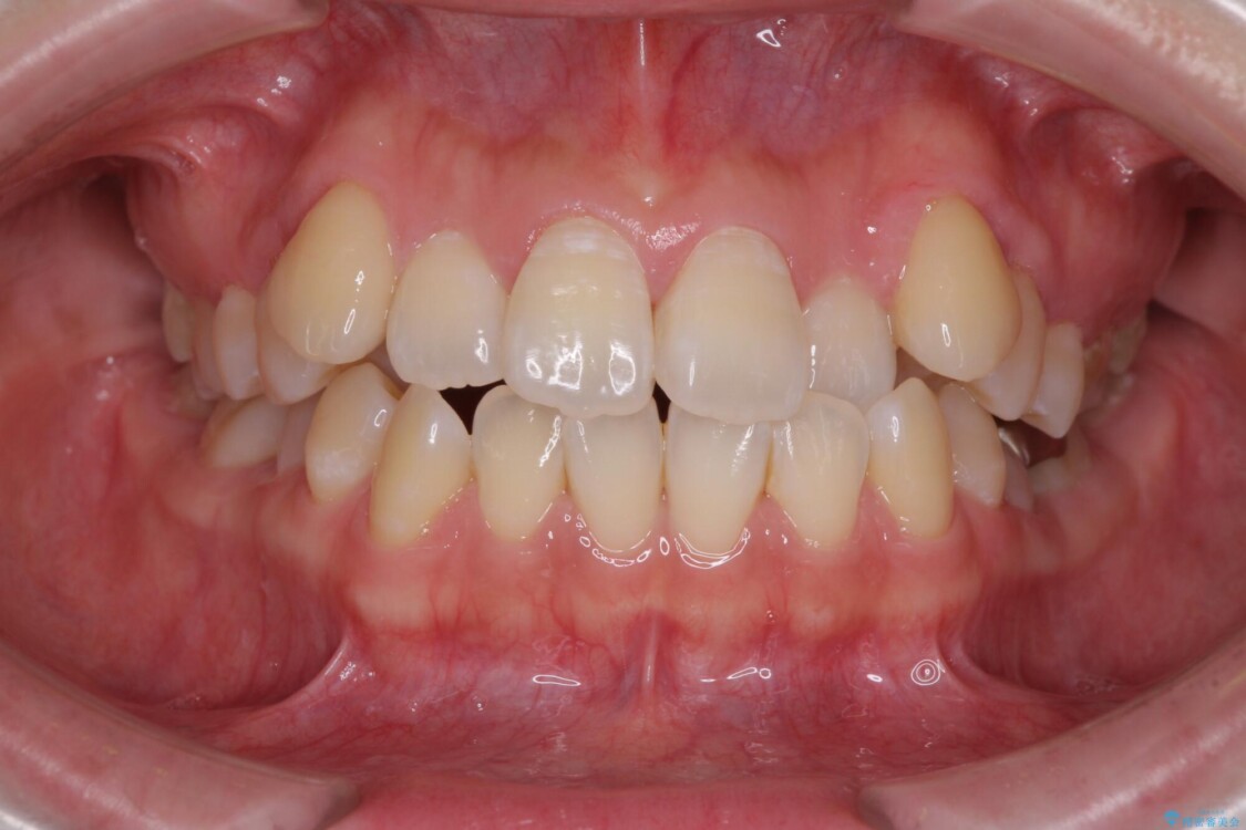 口元の突出感を改善　インビザラインによる非抜歯矯正 治療前