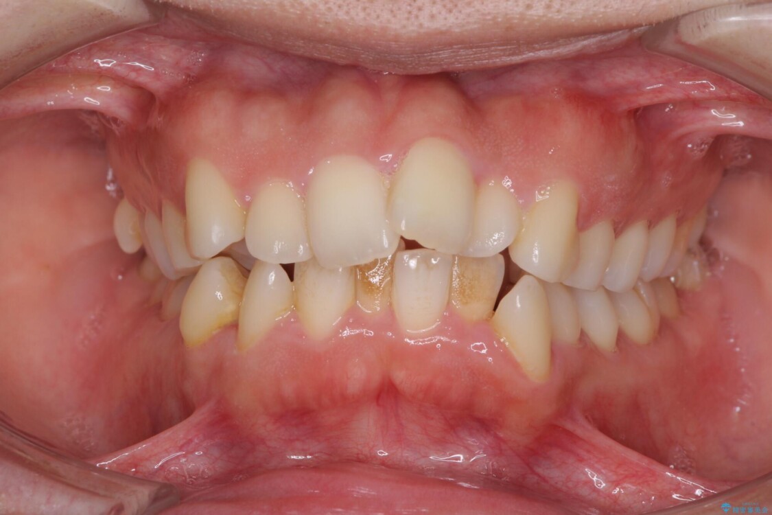 口元をスッキリと　ワイヤー装置による抜歯矯正 治療前