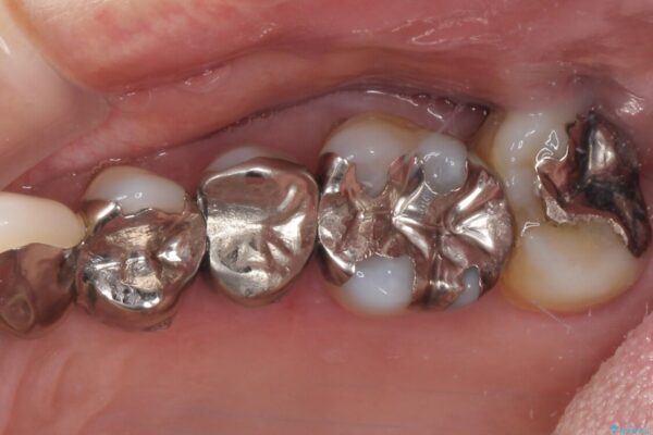 歯肉が腫れて出血する　奥歯の歯周病治療 治療前画像