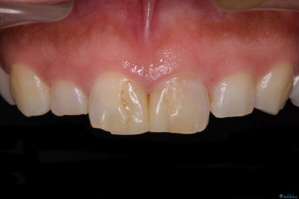 前歯の気になる変色、長さを整えてオールセラミッククラウンに 治療前画像