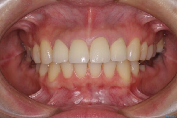 変色した歯をセラミックできれいに整える 治療後画像