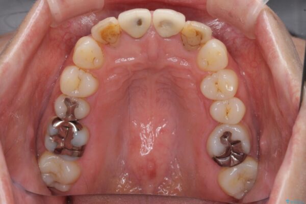 変色した歯をセラミックできれいに整える 治療前画像