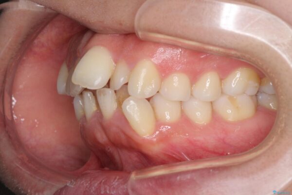 口元をスッキリと　ワイヤー装置による抜歯矯正 治療前画像