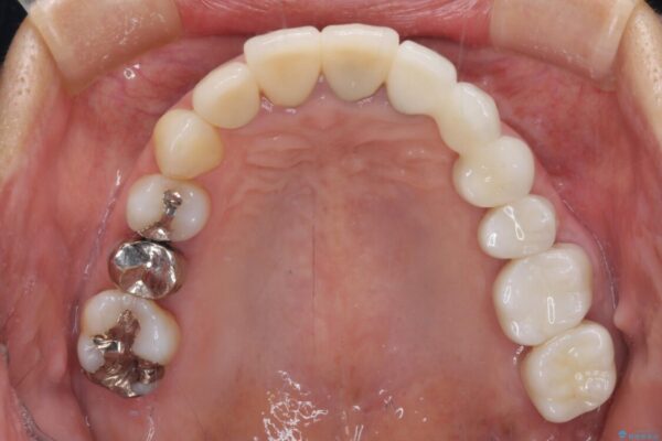 歯肉が腫れて出血する　奥歯の歯周病治療 治療後画像