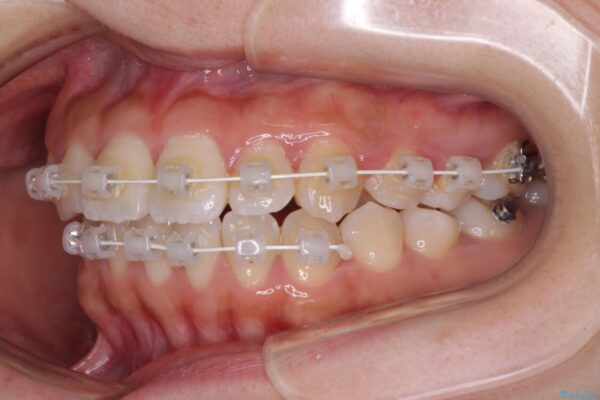 軽微な歯列不正をワイヤー矯正で整える 治療途中画像