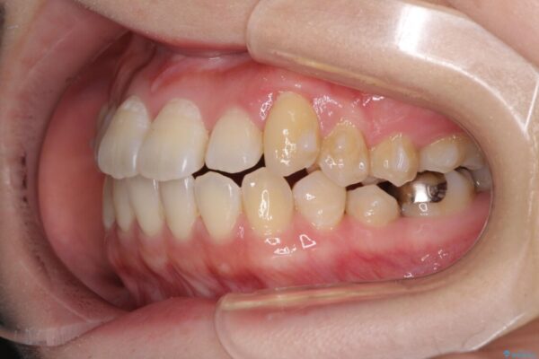 口元の突出感を改善　インビザラインによる非抜歯矯正 治療途中画像