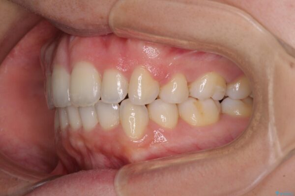 口元をスッキリと　ワイヤー装置による抜歯矯正 治療後画像