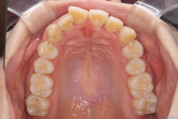 軽微な歯列不正をワイヤー矯正で整える 治療前画像