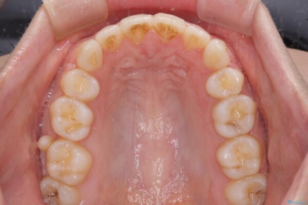 口元をスッキリと　ワイヤー装置による抜歯矯正 治療後画像