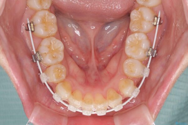 口元をスッキリと　ワイヤー装置による抜歯矯正 治療途中画像