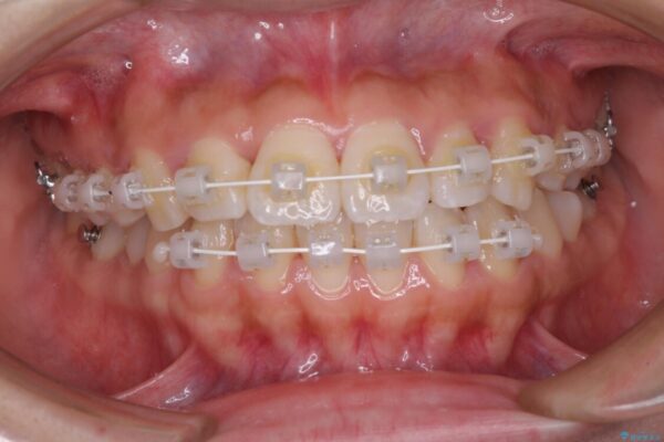 軽微な歯列不正をワイヤー矯正で整える 治療途中画像