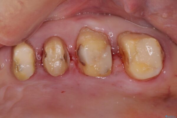 歯肉が腫れて出血する　奥歯の歯周病治療 治療途中画像