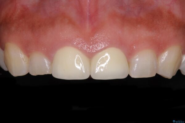 前歯の気になる変色、長さを整えてオールセラミッククラウンに 治療後画像