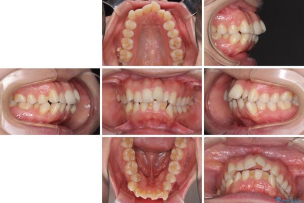 口元をスッキリと　ワイヤー装置による抜歯矯正 治療前画像