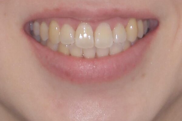 口元の突出感を改善　インビザラインによる非抜歯矯正 治療後画像
