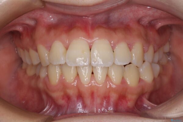 軽微な歯列不正をワイヤー矯正で整える 治療後画像