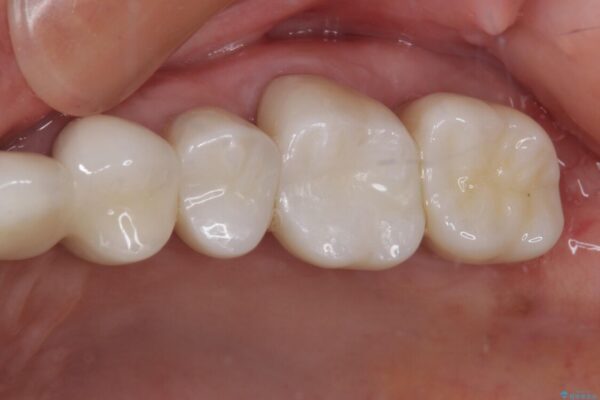 歯肉が腫れて出血する　奥歯の歯周病治療 治療後画像