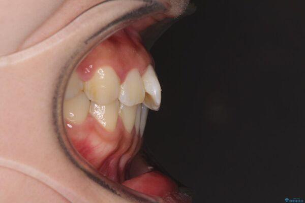 軽微な歯列不正をワイヤー矯正で整える 治療前画像