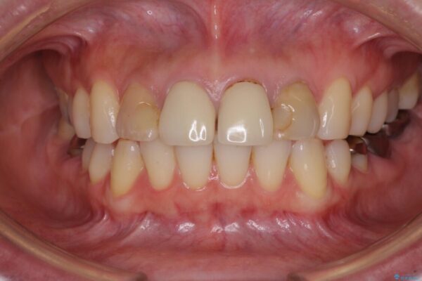 変色した歯をセラミックできれいに整える 治療前画像